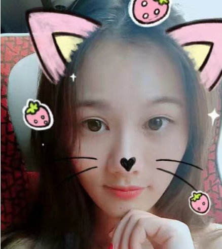 【双眼皮案例】广东美恩整形切开双眼皮果