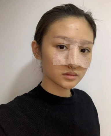 苏州美贝尔整形医生童列健鼻部多项案例分享!