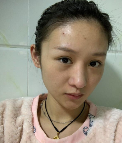 苏州美贝尔整形医生童列健鼻部多项案例分享!