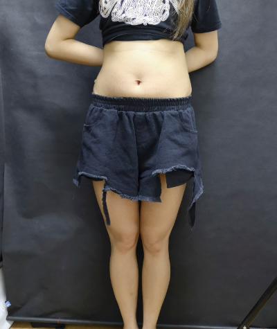 北京达美如艺医生秦继锋大腿吸脂案例分享!