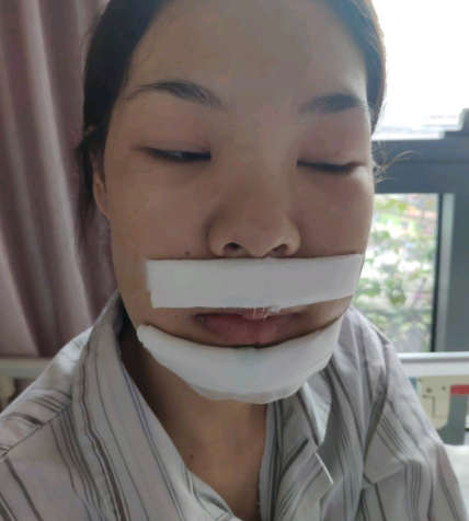 佛山市禅城区中心医院下颚前突矫正案例!