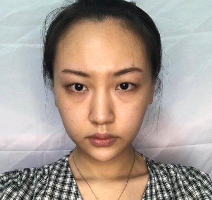 上海光博士医疗美容医生李彬眼部多项案例分享
