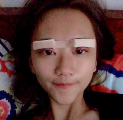 汕头华美医美医院切开双眼皮案例分享!