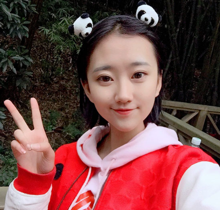 汕头华美医美医院切开双眼皮案例分享!