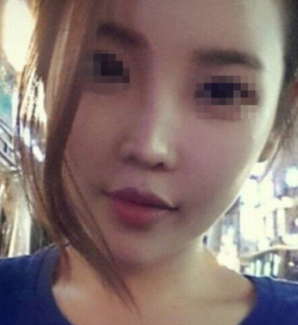 南京康美美容医生夏尧龙注射瘦脸+丰额术后果