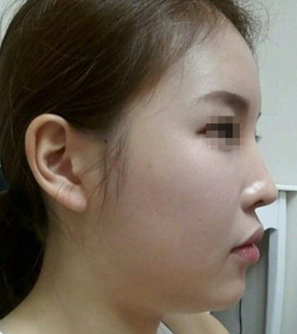 南京康美美容医生夏尧龙注射瘦脸+丰额术后果