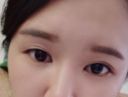 成都美极医疗美容自切开双眼皮案例分享!