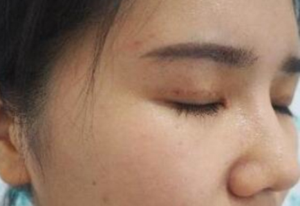 成都美极医疗美容自切开双眼皮案例分享!