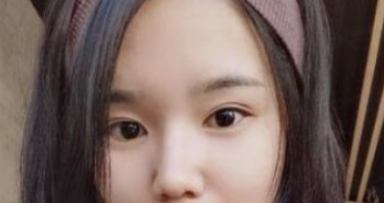 成都美极医疗美容自切开双眼皮案例分享!