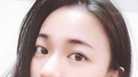 成都米亚整形埋线双眼皮案例分享!坐标:四川