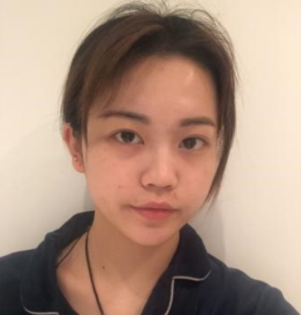 上上相医美医生侯月华自体脂肪全脸填充案例!