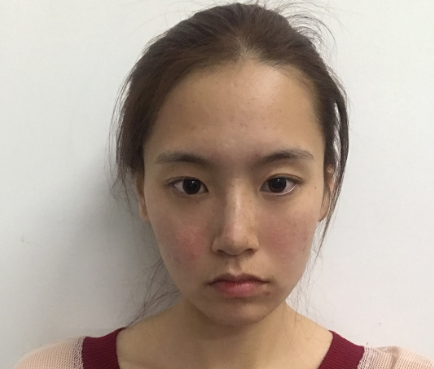 上海光博士医生彭正春热提拉案例分享!