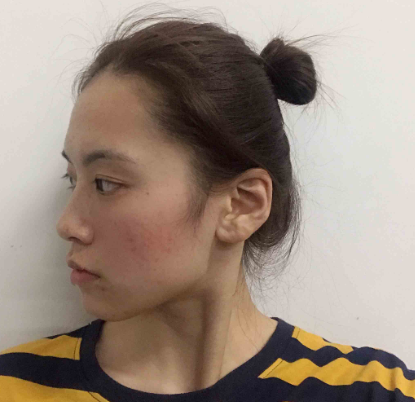 上海光博士医生彭正春热提拉案例分享!