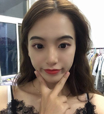 上海光博士医生彭正春热提拉案例分享!