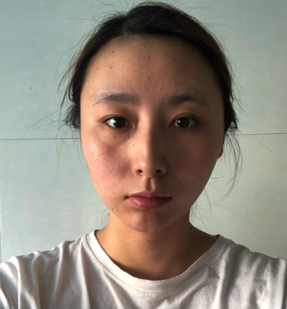 苏州肤康皮肤科医院点阵激光案例分享!