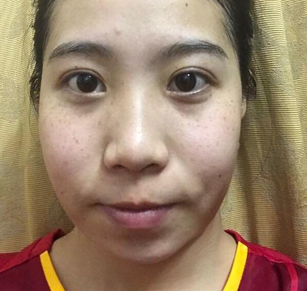 深圳瑞利医疗美容门诊部埋线提升提升案例分享!