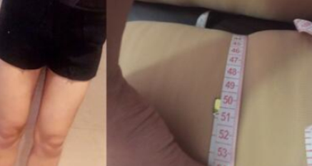 东莞华美医疗美容腿部吸脂术后50天果分享!
