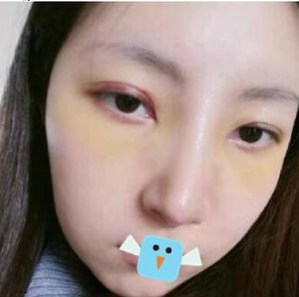 成都医大医生虞冬梅鼻部手术术后分享附对比图!