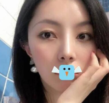 成都医大医生虞冬梅鼻部手术术后分享附对比图!