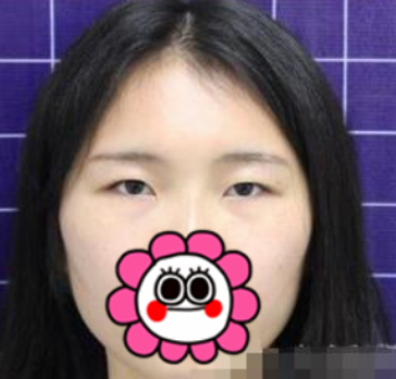 内蒙古爱美者眼部手术手术面诊手术过程分享!