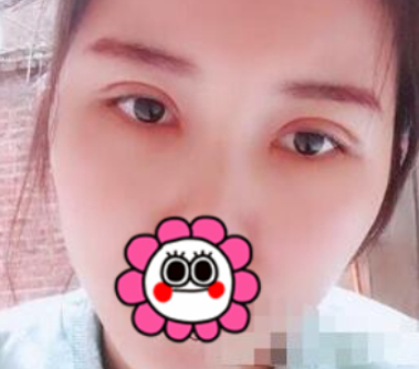 内蒙古爱美者眼部手术手术面诊手术过程分享!