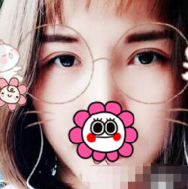 内蒙古爱美者眼部手术手术面诊手术过程分享!