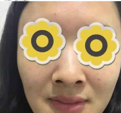 广州华美医疗美容医院膨体隆鼻术后3月带果图