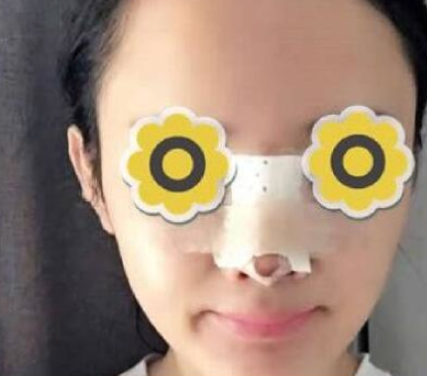 广州华美医疗美容医院膨体隆鼻术后3月带果图