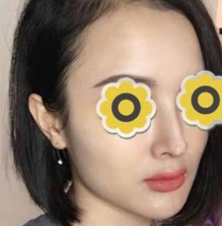 广州华美医疗美容医院膨体隆鼻术后3月带果图