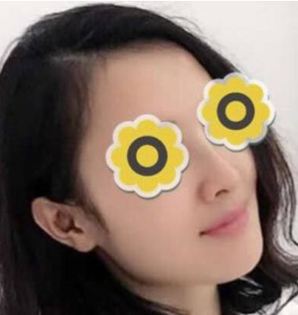 广州华美医疗美容医院膨体隆鼻术后3月带果图