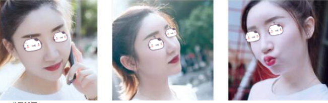徐州小姐姐鼻部手术术后感受及果分享!