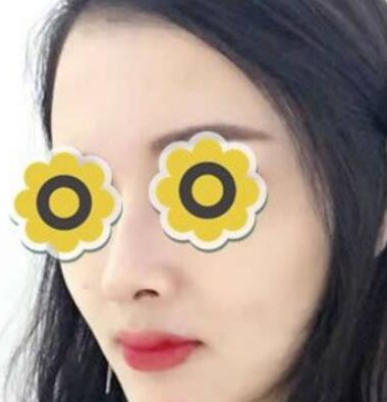 广州华美医疗美容医院膨体隆鼻术后3月带果图