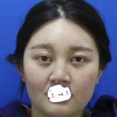 西安美莱医美注射注射瘦脸案例分享！