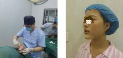 南京美贝尔医美医生黄名斗假体下巴案例分享!