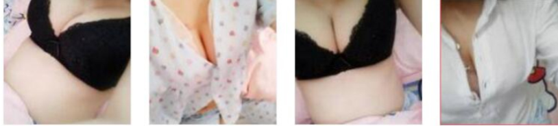 福州美贝尔医美医生张胜利乳房缩小案例分享!