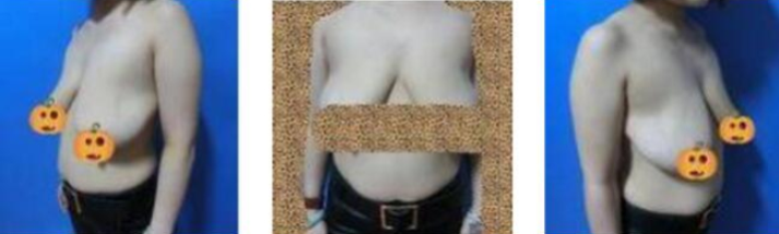 福州美贝尔医美医生张胜利乳房缩小案例分享!