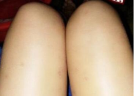 郑州悦美医美大腿吸脂果怎么样?