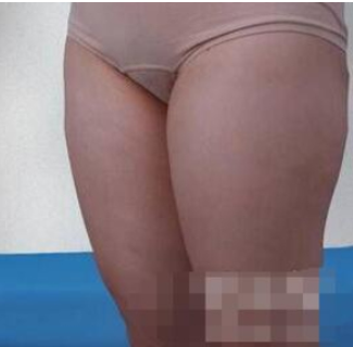 天津唯美医美大腿吸脂术后两月果分享！