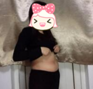 重庆时光医美腰腹吸脂案例分享附果图!