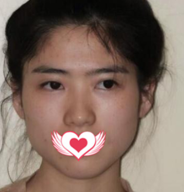 南宁婉美医美面部磨骨术后果分享!