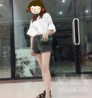 天津唯美医美大腿吸脂术后两月果分享！