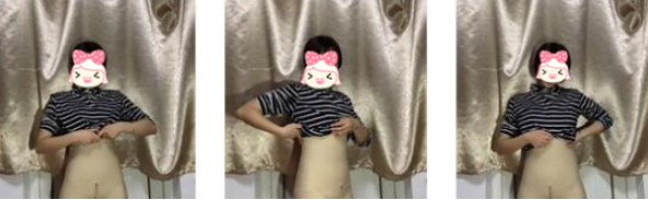 重庆时光医美腰腹吸脂案例分享附果图!