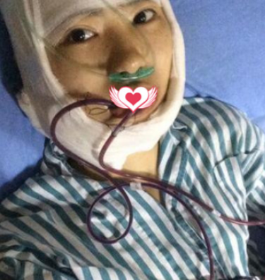 南宁婉美医美面部磨骨术后果分享!
