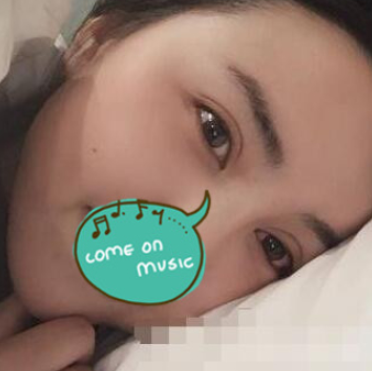 【双眼皮案例】温州和平医院切开双眼皮果