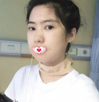 南宁婉美医美面部磨骨术后果分享!