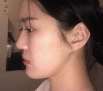 上海薇琳医疗美容医院面部吸脂术后100天果