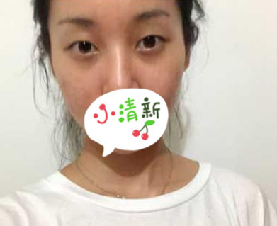医美切开双眼皮术后三月分享附果图