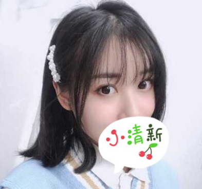 医美切开双眼皮术后三月分享附果图