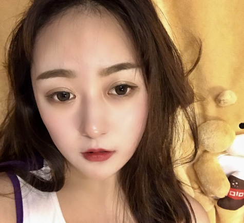 温州小姐姐鼻部多项术后45天带果图分享!