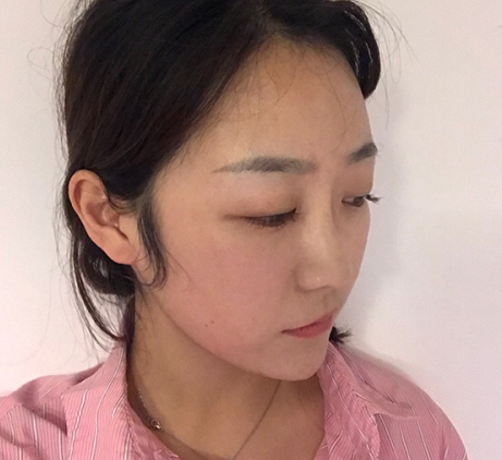 温州小姐姐鼻部多项术后45天带果图分享!